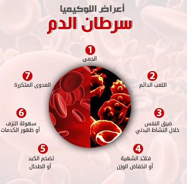 العلاج بالخلايا التائية ذات مستقبلات المستضدات الوهمية يمنح الأمل لمرضى سرطان الدم (اللوكيميا)